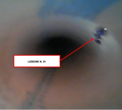 Prima lesione indicata dalla freccia nella videoispezione