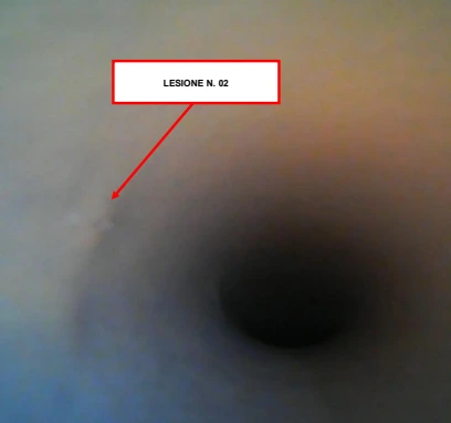 Seconda lesione indicata dalla freccia nella videoispezione