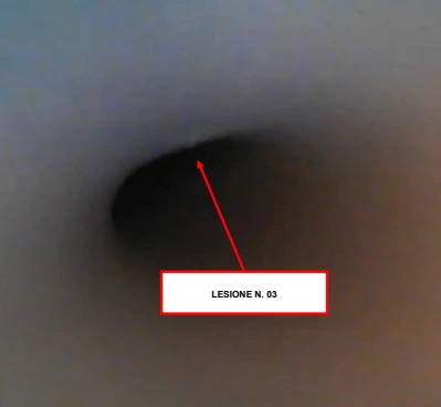 Terza lesione indicata dalla freccia nella videoispezione